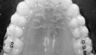 Myaligner