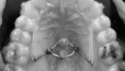 Myaligner com ancoragem esquelética