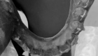 Myaligner